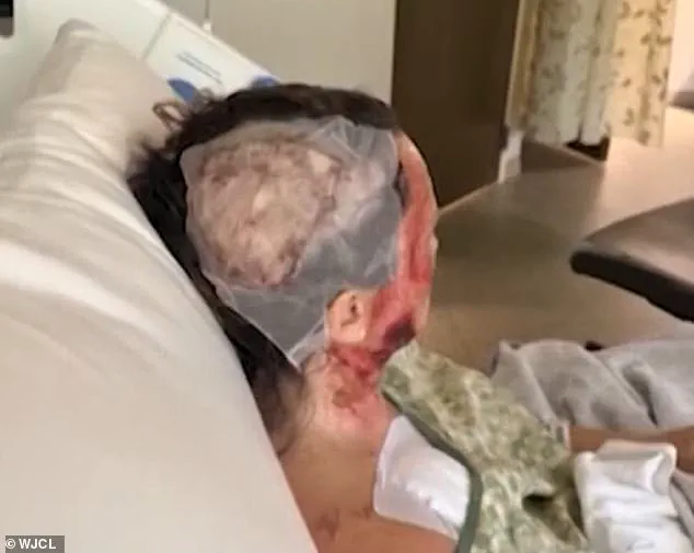 Woman Suffers Acid Attack in Savannah Park