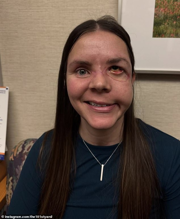 Kenai Mother Reveals Full Severity of Bear Attack Injuries